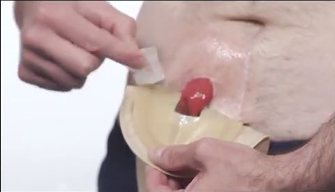 a man applying an ostomy pouch