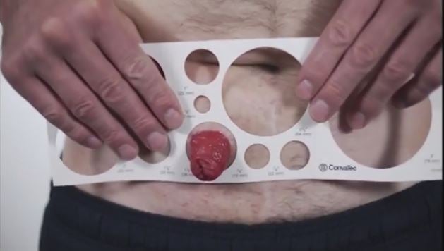 a close-up of how to size a stoma