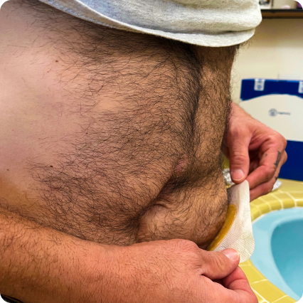 close-up of a stomach with a stoma