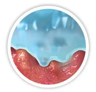 tekening van microcontouren naar wondbed