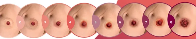Fasi dei problemi della pelle peristomale.