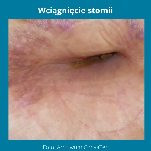 Wpadnięcie stomii - zdjęcie