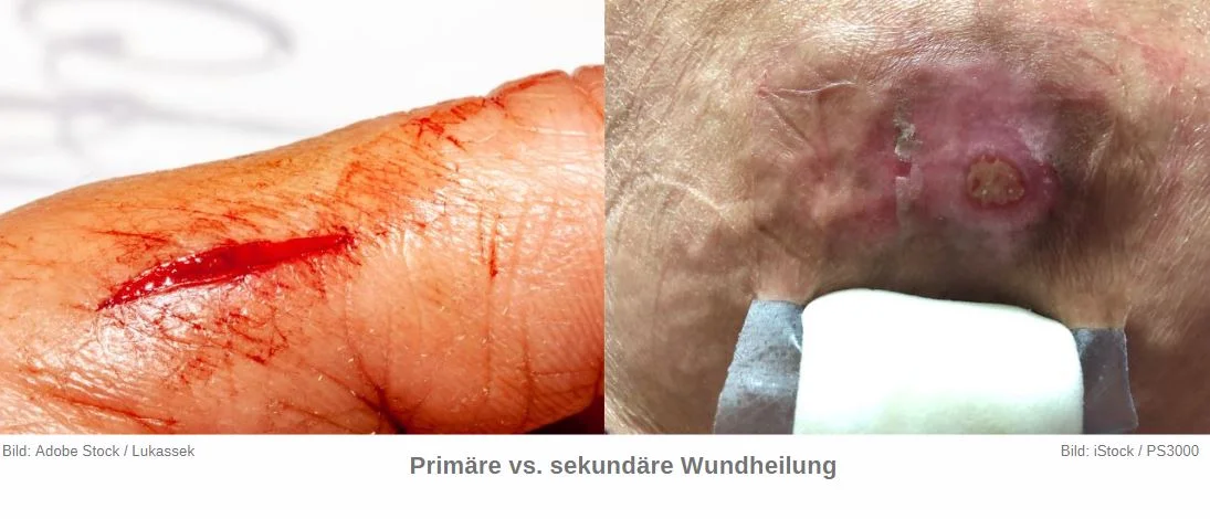 Prim&auml;are vs. sekund&auml;re Wundheilung